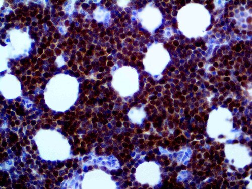 IHC of CDK2 on an FFPE Lymphoblastic Lymphoma Tissue